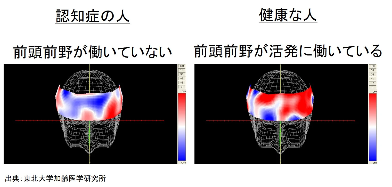 健康な人と認知症の人の脳の働き方の違いは？